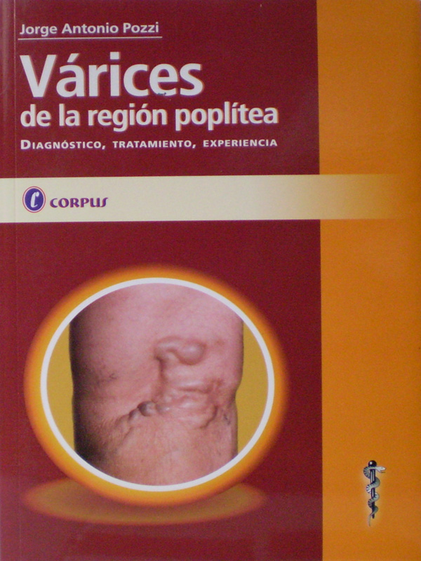 Libro: Varices de la Region Poplitea, Diagnostico, Tratamiento, Experiencia Autor: Jorge Antonio Pozzi